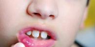 Treatment of stomatitis in children 3 years old